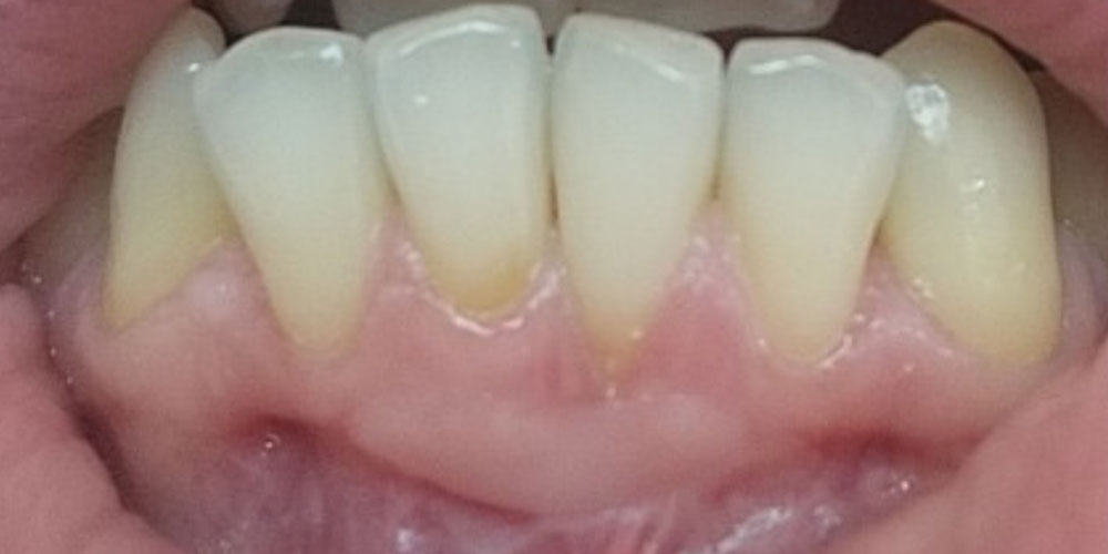 paradonotopatija1-posle