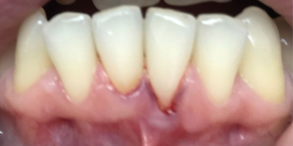 paradonotopatija1-pre