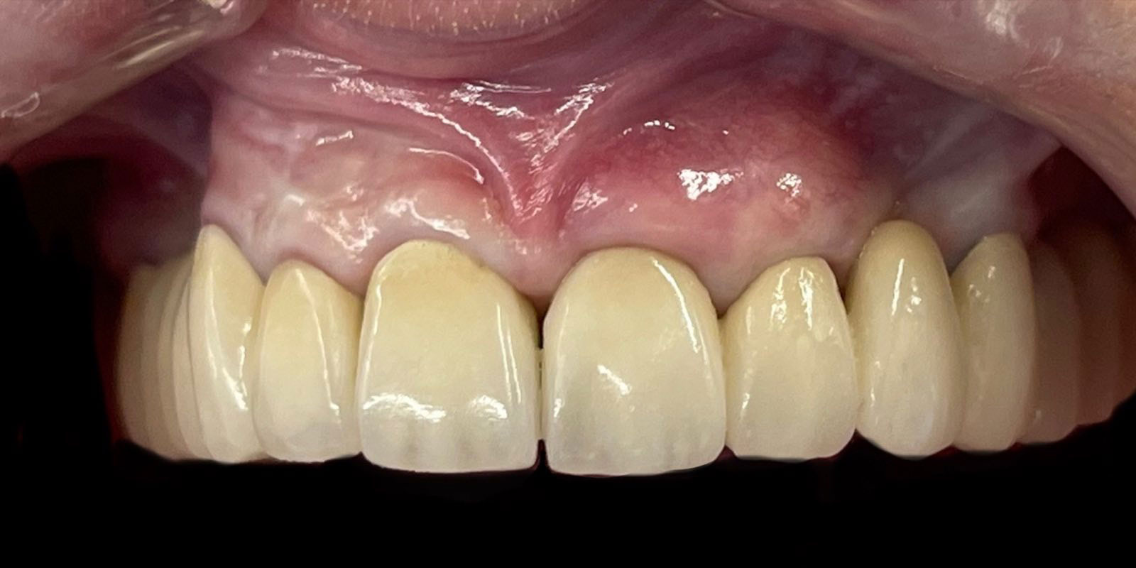 paradonotopatija2-posle