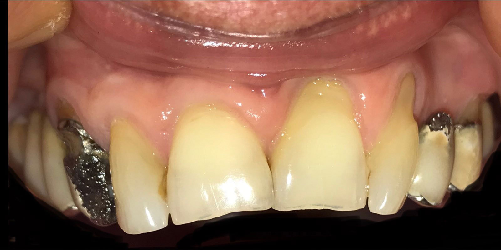 paradonotopatija2-pre