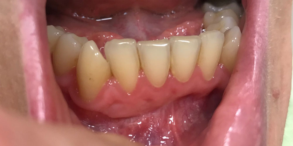 paradonotopatija3-posle