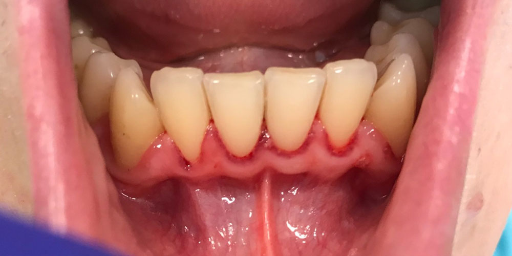 paradonotopatija3-pre